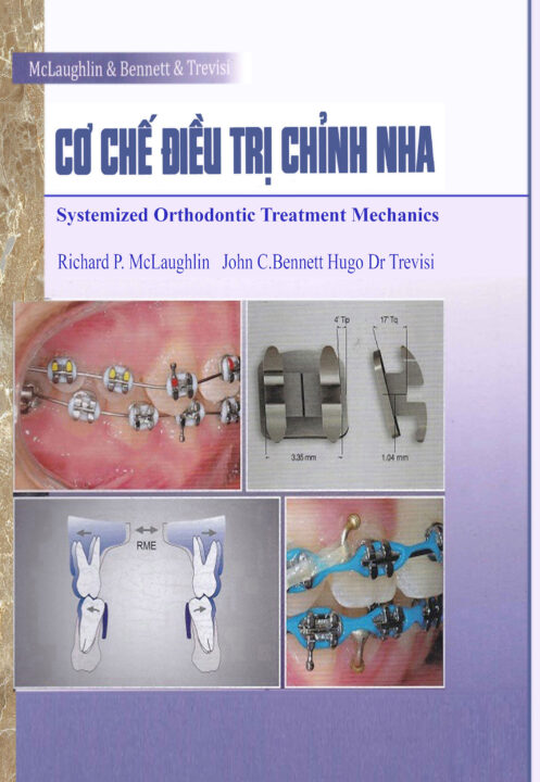 Cơ chế điều trị chỉnh nha